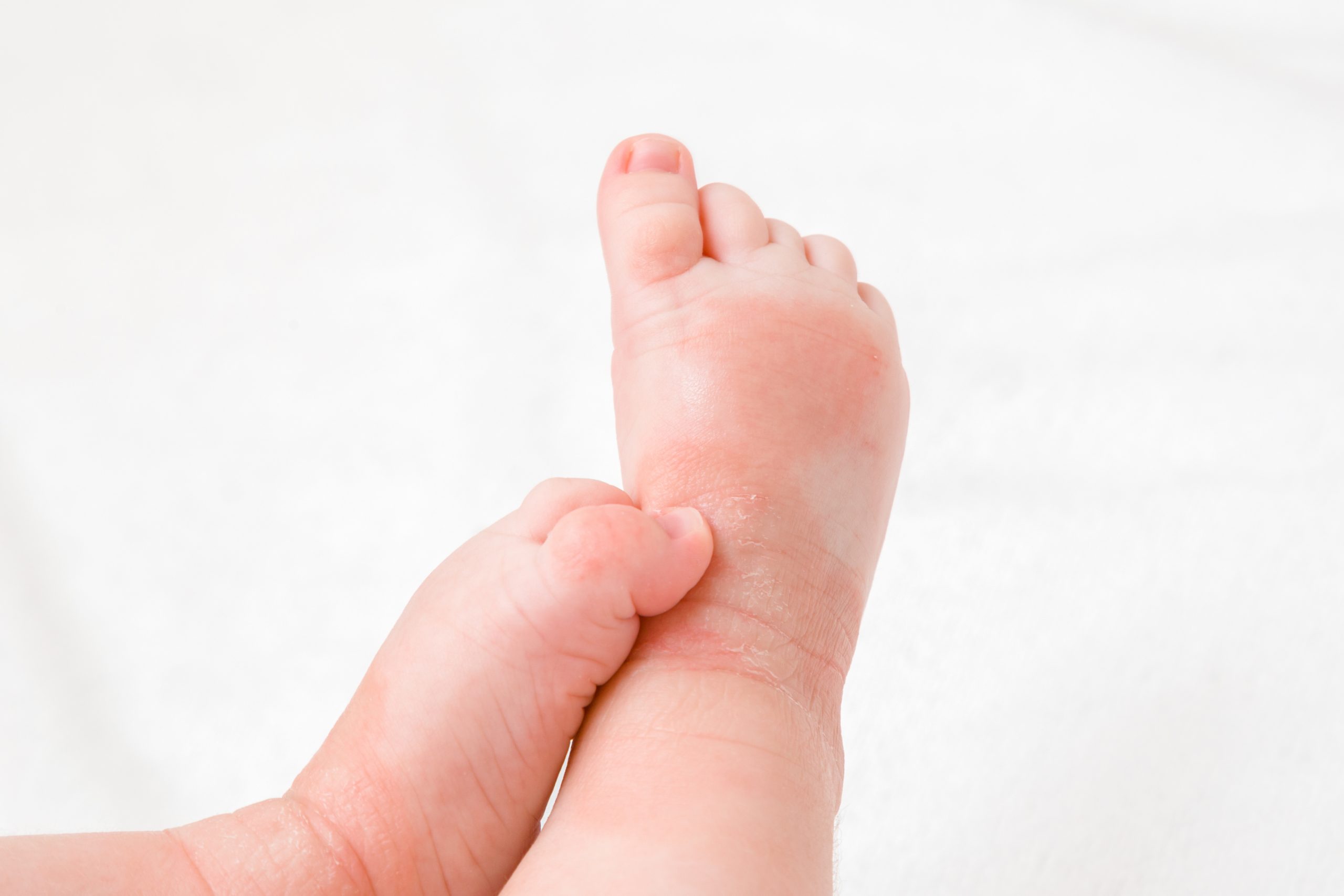 Infant Legs With Red Dry Skin. Suffering From Allergy Of Milkprotein